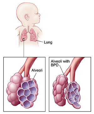 Front view of newborn's head and chest showing lungs with one inset showing normal alveoli and another inset showing bronchopulmonary dysplasia.