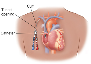 Outline of man's chest showing a tunneled catheter entering the right atrium of the heart. 