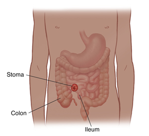 Front view of child's body showing the digestive tract and a stoma.