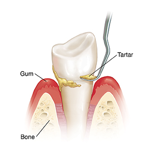 Side view of tooth in bone with instrument doing scaling of tartar..