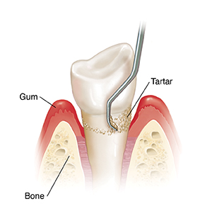 Side view of tooth in bone showing instrument doing planing of tartar.