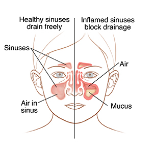 Front view of child’s face showing normal sinuses on one side and inflamed sinuses on the other.