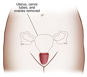 Front view of female pelvis showing reproductive organs and dotted line outlining uterus, cervix , fallopian tubes, and ovaries to show hysterectomy with removal of ovaries.