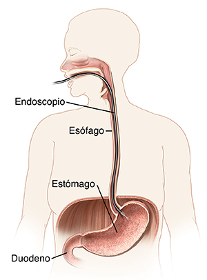 Contorno de mujer donde pueden verse la boca, el esófago y el estómago con un endoscopio insertado a través de la boca hasta el estómago.