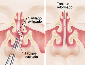 Vista frontal del antes y el después de una cara en la que se ven los senos paranasales y la reparación de un tabique desviado.